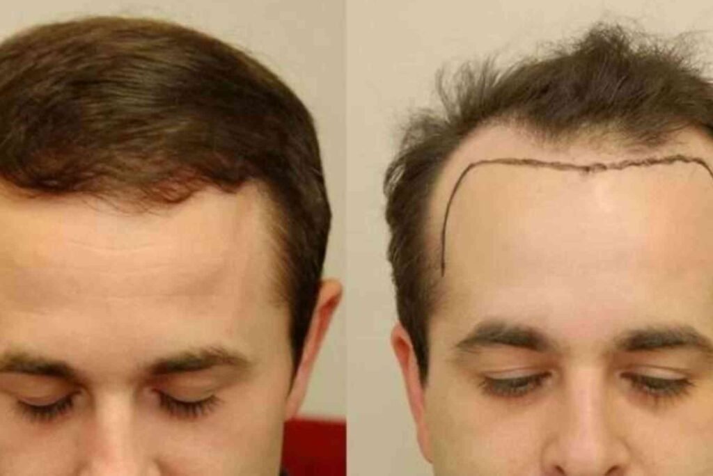 Hair Transplant Turkey